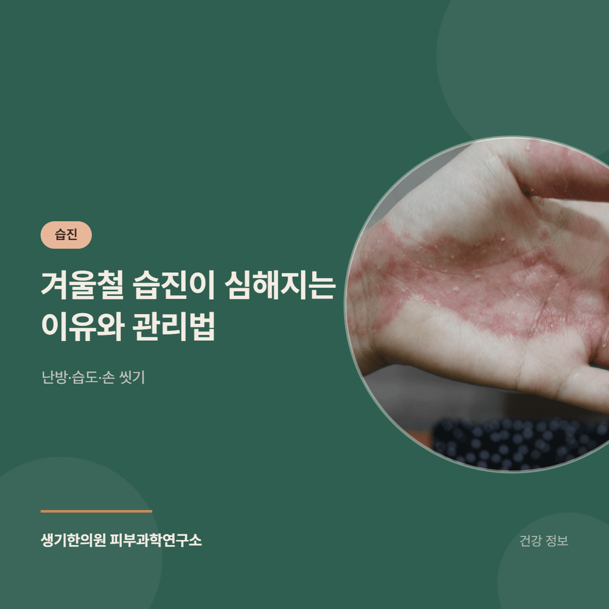겨울철 습진이 심해지는 이유와 관리법 — 난방·습도·손 씻기 대표 이미지