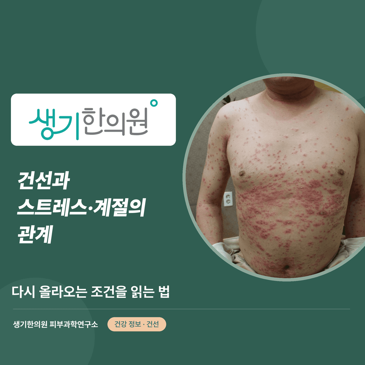 건선과 스트레스·계절의 관계 — 다시 올라오는 조건을 읽는 법 대표 이미지
