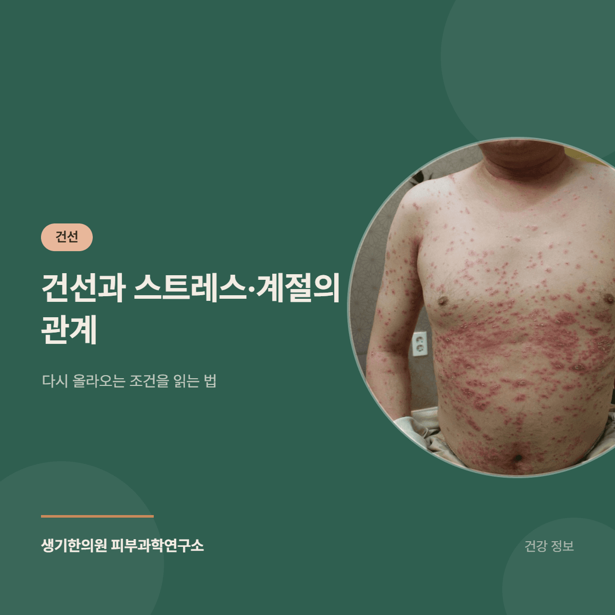 건선과 스트레스·계절의 관계 — 다시 올라오는 조건을 읽는 법 대표 이미지