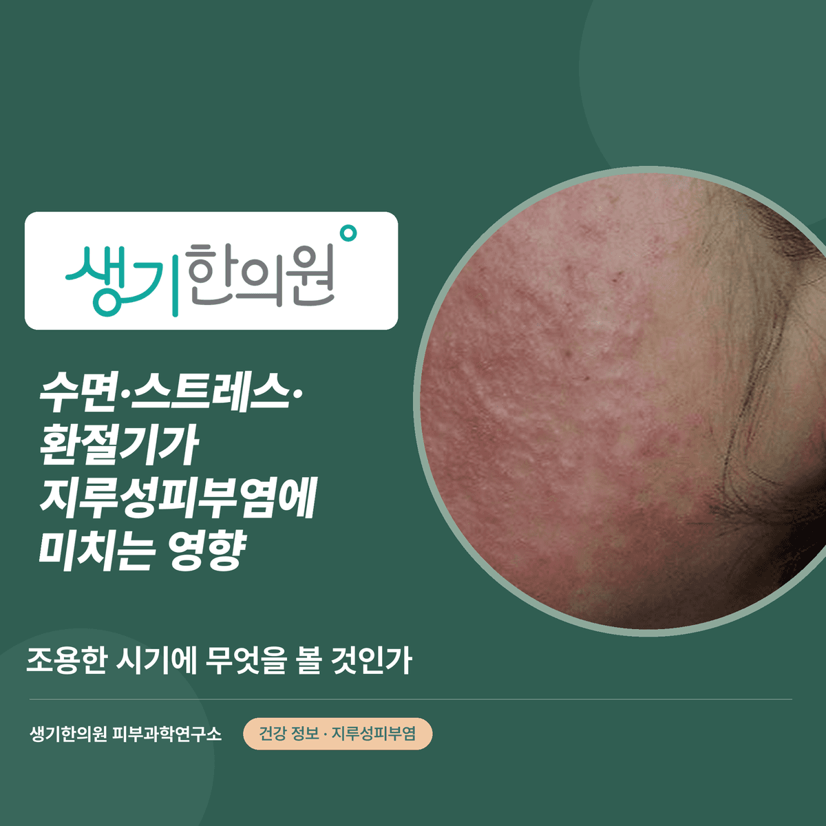 수면·스트레스·환절기가 지루성피부염에 미치는 영향 — 조용한 시기에 무엇을 볼 것인가 대표 이미지