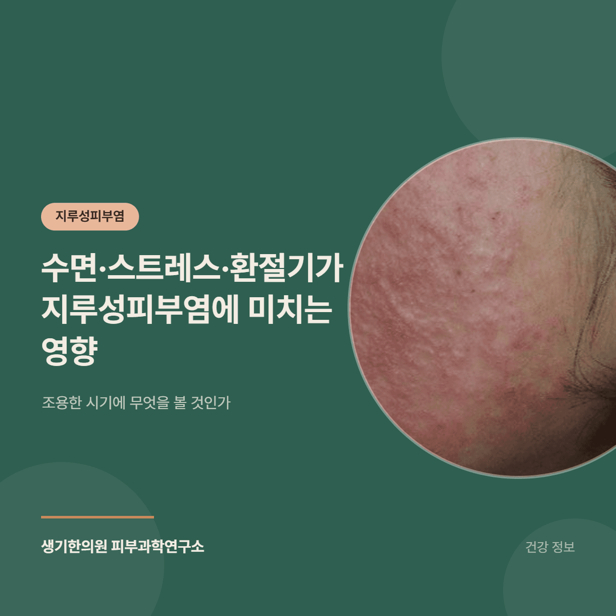 수면·스트레스·환절기가 지루성피부염에 미치는 영향 — 조용한 시기에 무엇을 볼 것인가 대표 이미지