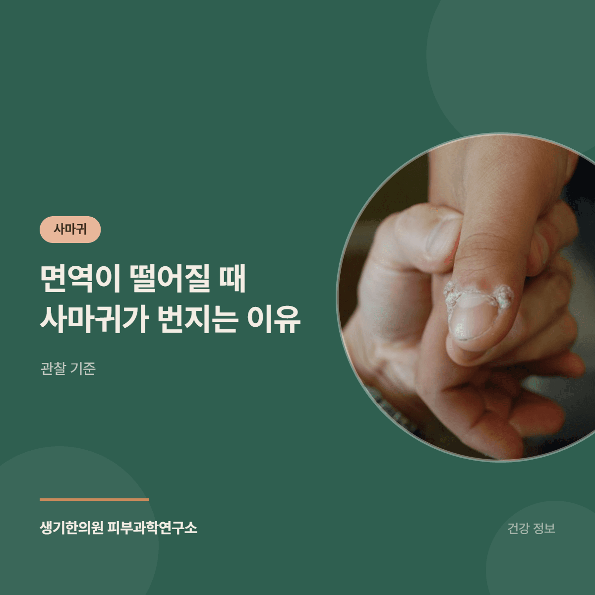 면역이 떨어질 때 사마귀가 번지는 이유 — 관찰 기준 대표 이미지