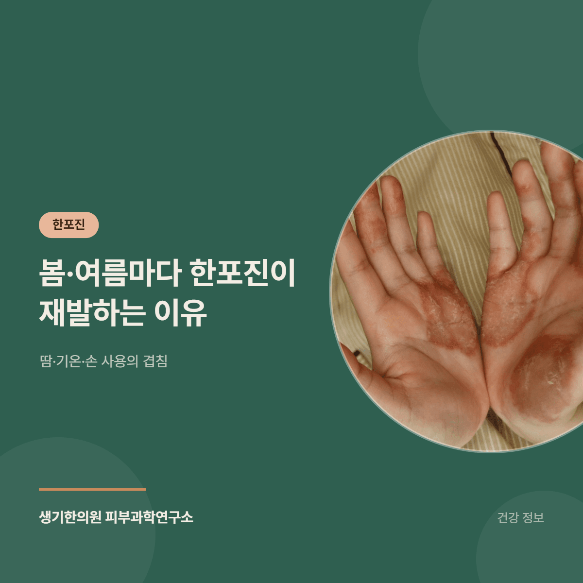 봄·여름마다 한포진이 재발하는 이유 — 땀·기온·손 사용의 겹침 대표 이미지