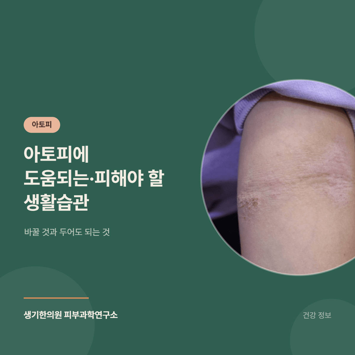 아토피에 도움되는·피해야 할 생활습관 — 바꿀 것과 두어도 되는 것 대표 이미지