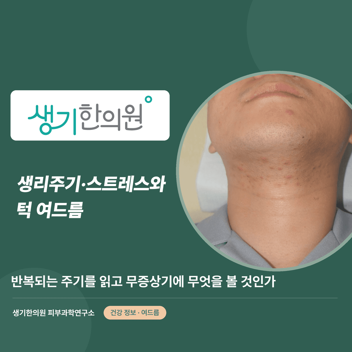 생리주기·스트레스와 턱 여드름 — 반복되는 주기를 읽고 무증상기에 무엇을 볼 것인가 대표 이미지