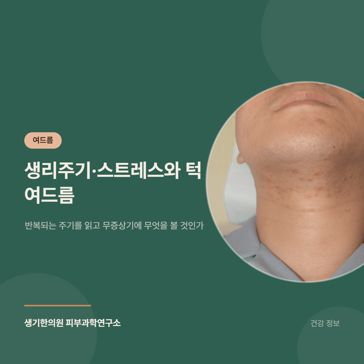 생리주기·스트레스와 턱 여드름 — 반복되는 주기를 읽고 무증상기에 무엇을 볼 것인가 대표 이미지