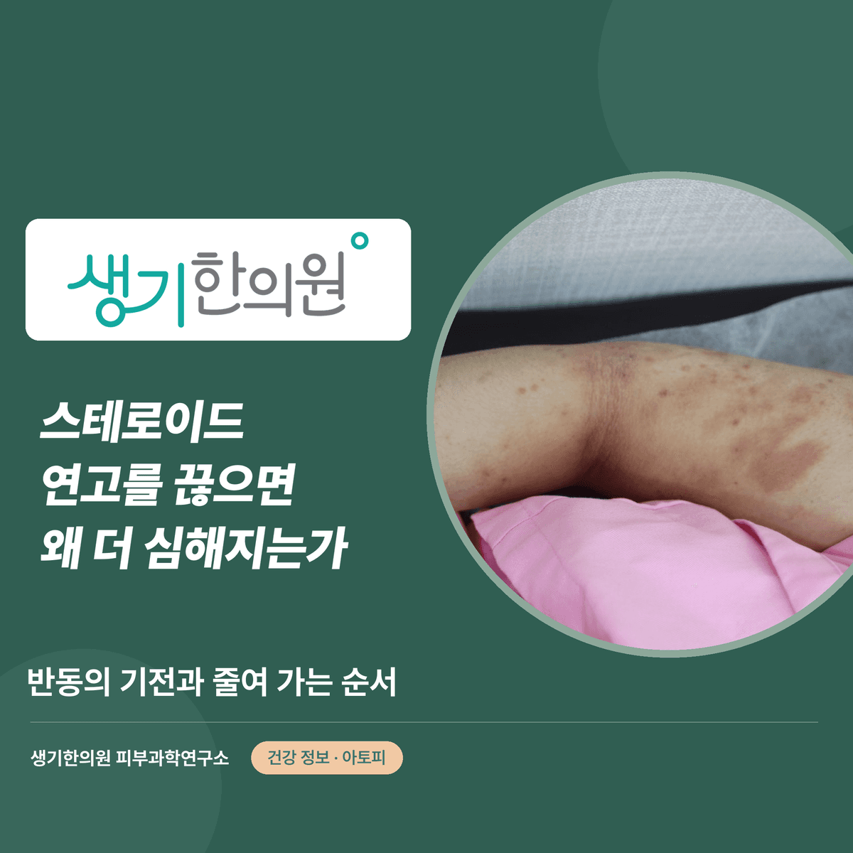 스테로이드 연고를 끊으면 왜 더 심해지는가 — 반동의 기전과 줄여 가는 순서 대표 이미지