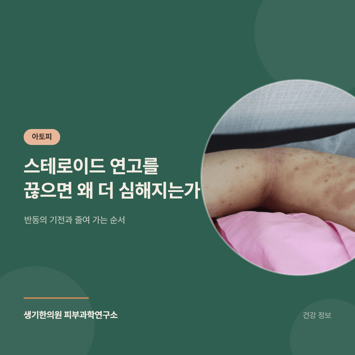 스테로이드 연고를 끊으면 왜 더 심해지는가 — 반동의 기전과 줄여 가는 순서 대표 이미지