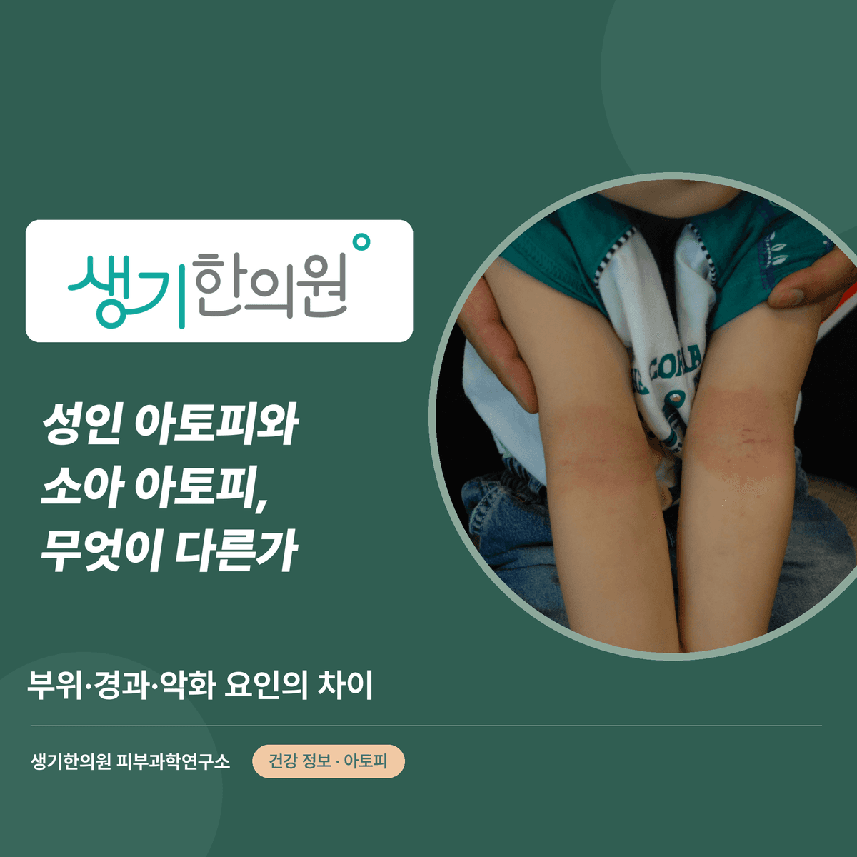 성인 아토피와 소아 아토피, 무엇이 다른가 — 부위·경과·악화 요인의 차이 대표 이미지