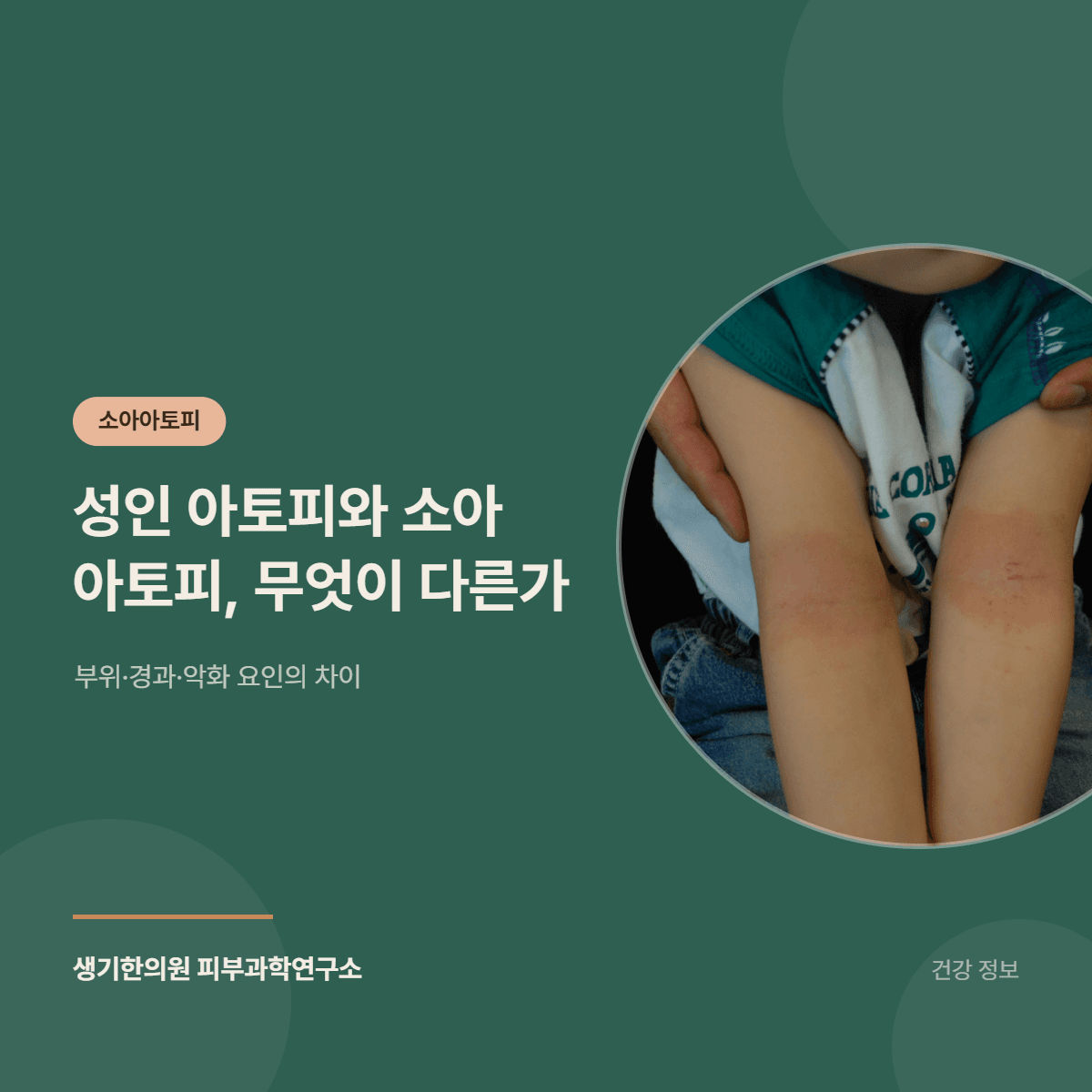 성인 아토피와 소아 아토피, 무엇이 다른가 — 부위·경과·악화 요인의 차이 대표 이미지
