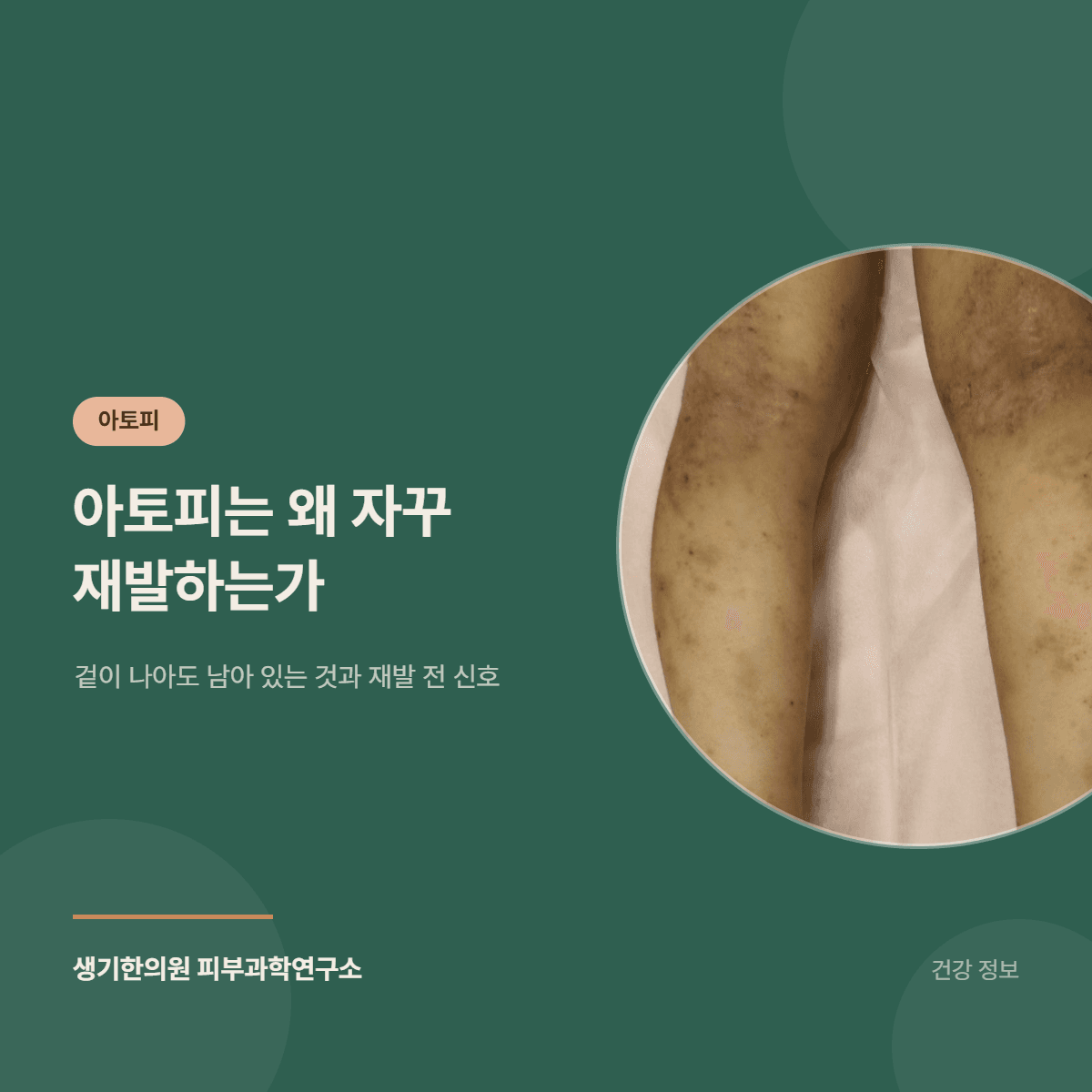 아토피는 왜 자꾸 재발하는가 — 겉이 나아도 남아 있는 것과 재발 전 신호 대표 이미지