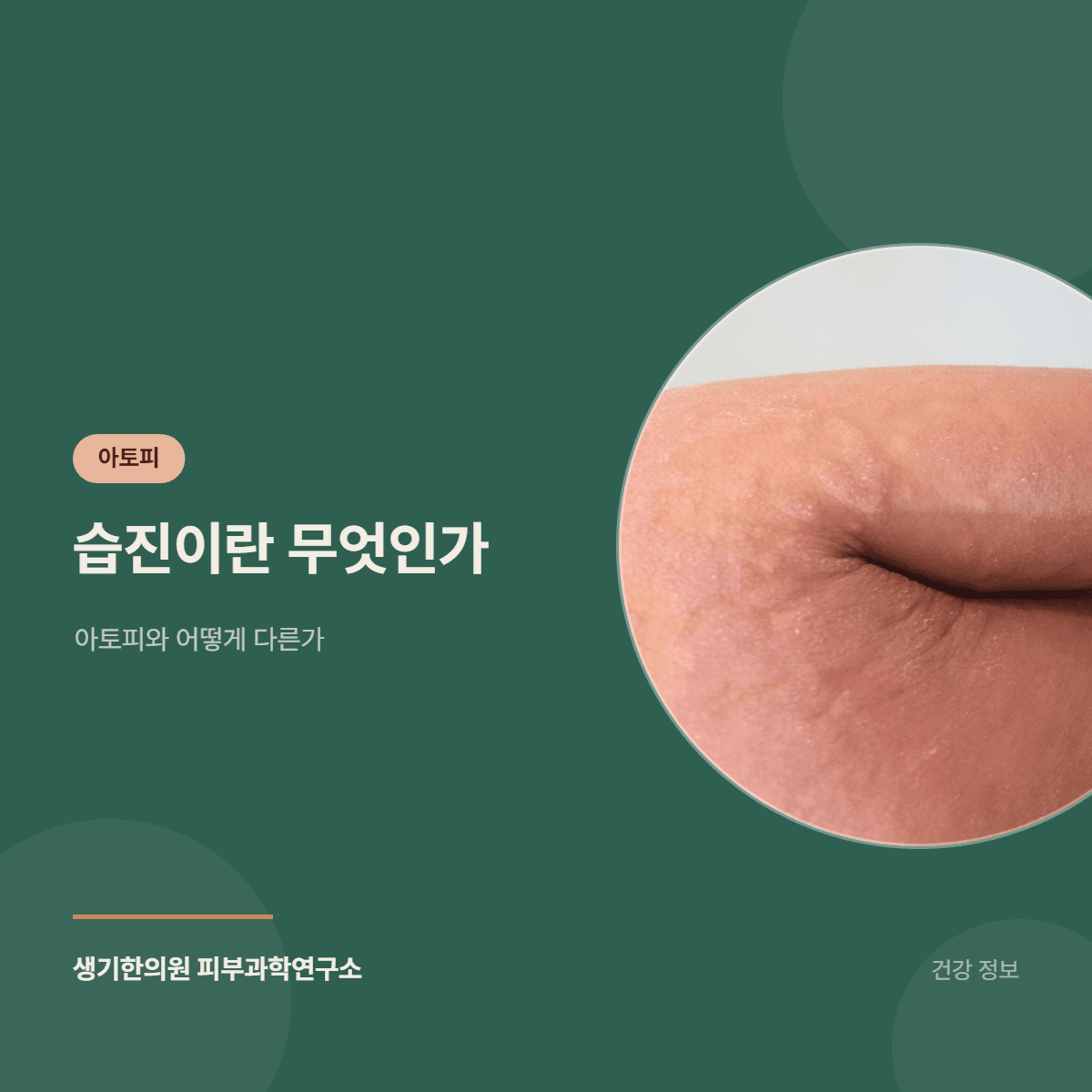 습진이란 무엇인가 — 아토피와 어떻게 다른가 대표 이미지