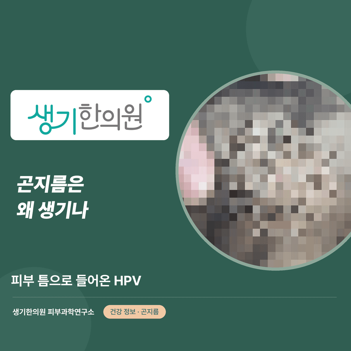 곤지름은 왜 생기나 — 피부 틈으로 들어온 HPV 대표 이미지