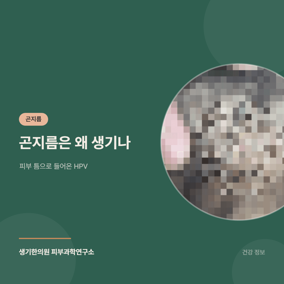 곤지름은 왜 생기나 — 피부 틈으로 들어온 HPV 대표 이미지