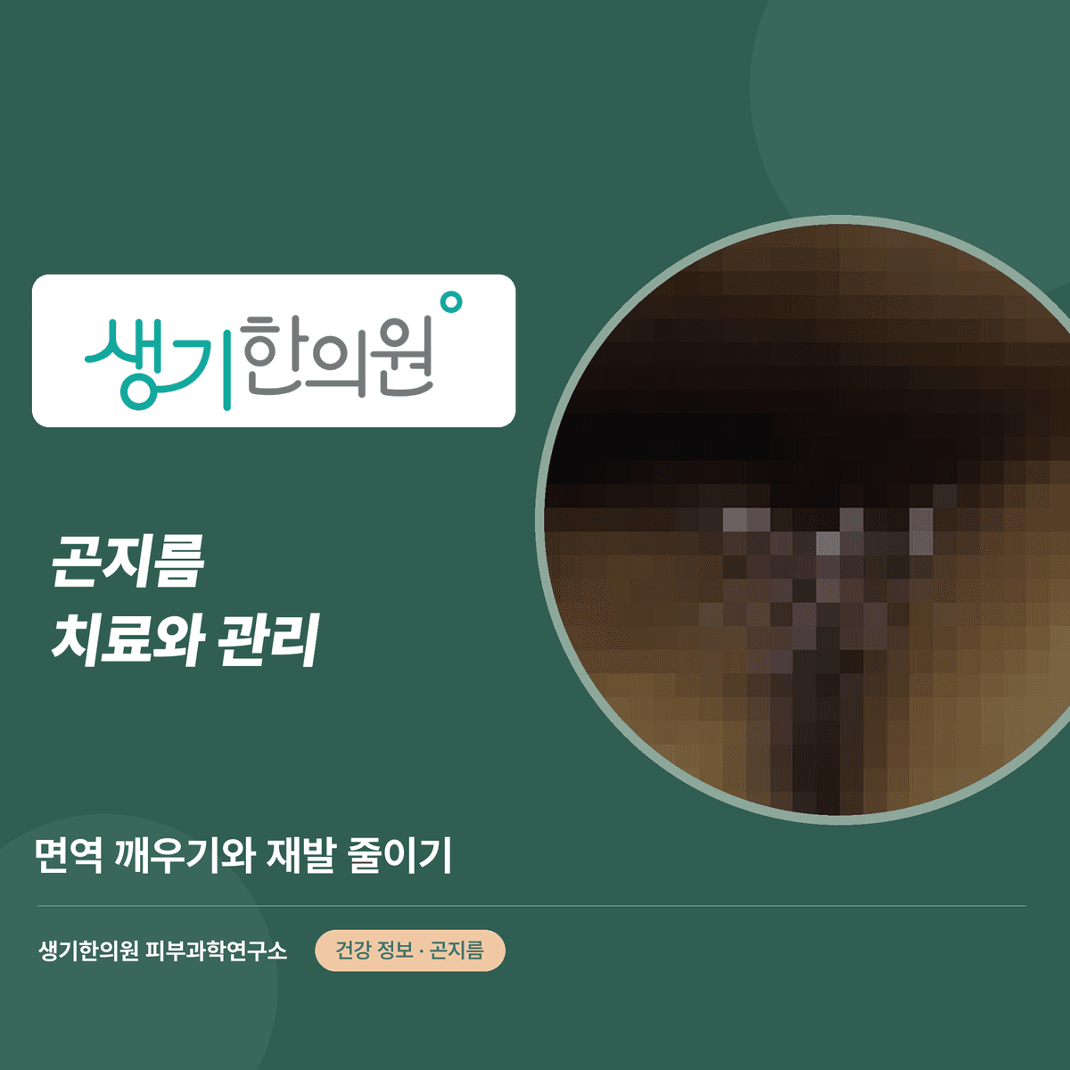 곤지름 치료와 관리 — 면역 깨우기와 재발 줄이기 대표 이미지