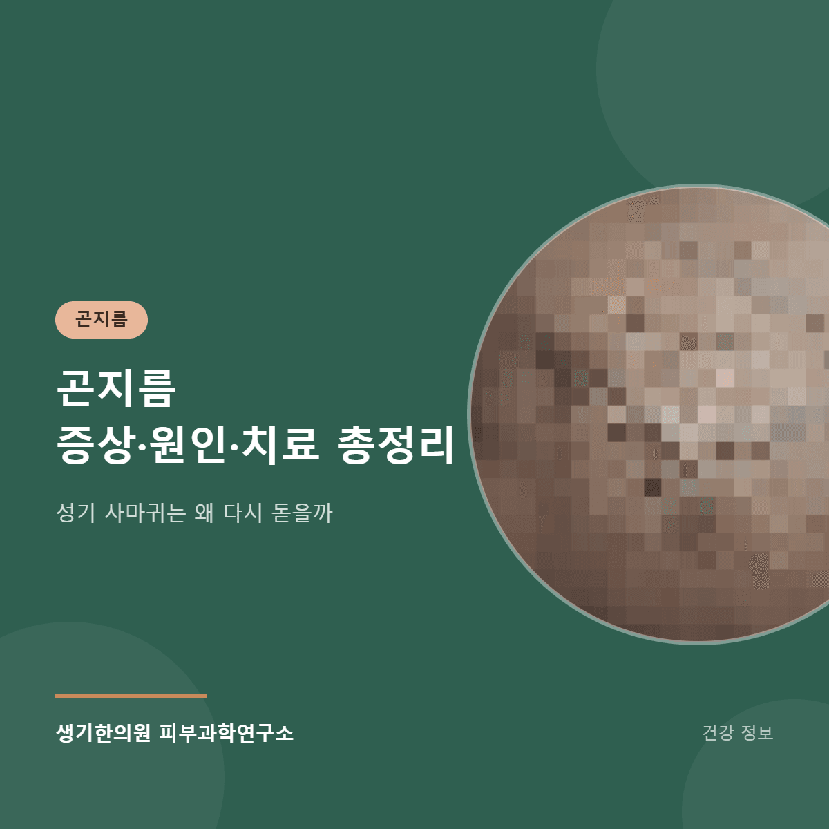 곤지름 증상·원인·치료 총정리 대표 이미지