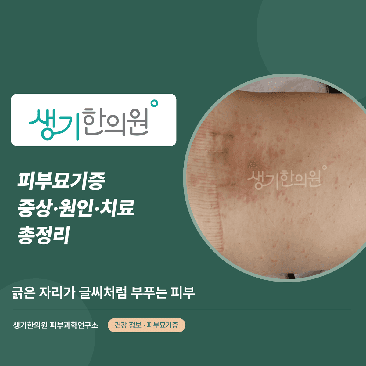 피부묘기증 증상·원인·치료 총정리 대표 이미지