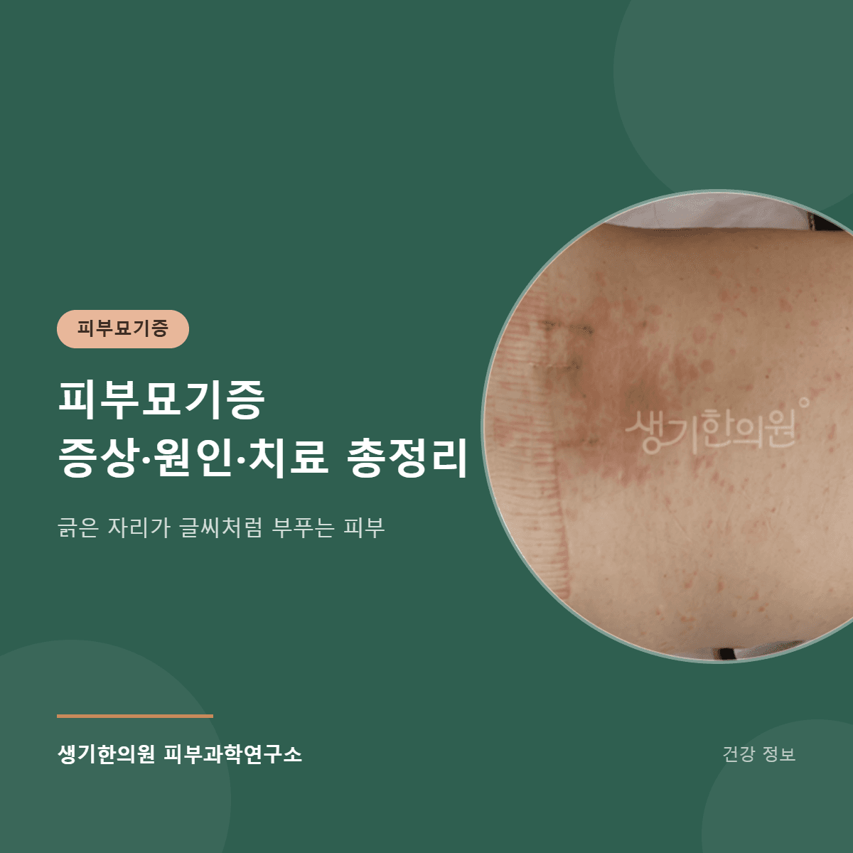 피부묘기증 증상·원인·치료 총정리 대표 이미지