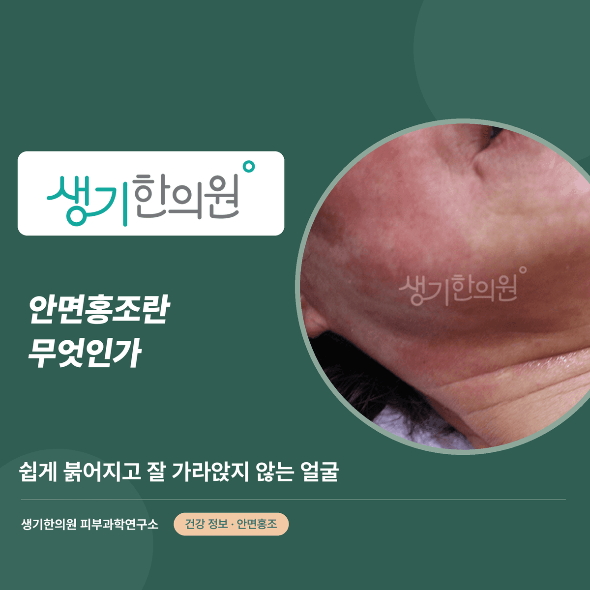 안면홍조란 무엇인가 — 쉽게 붉어지고 잘 가라앉지 않는 얼굴 대표 이미지