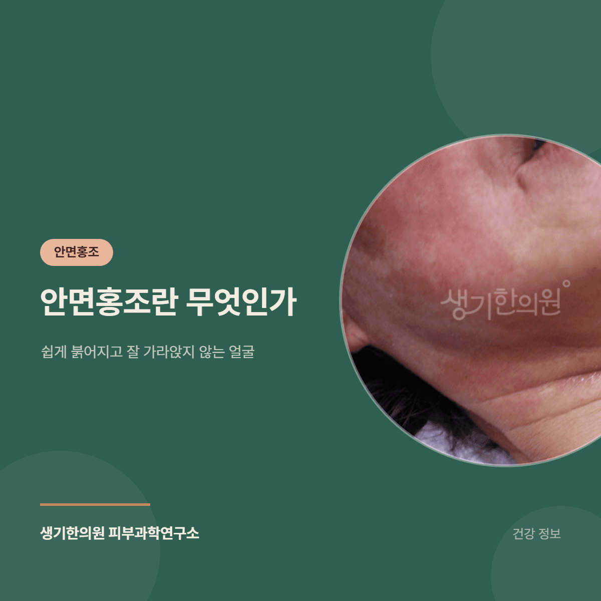 안면홍조란 무엇인가 — 쉽게 붉어지고 잘 가라앉지 않는 얼굴 대표 이미지