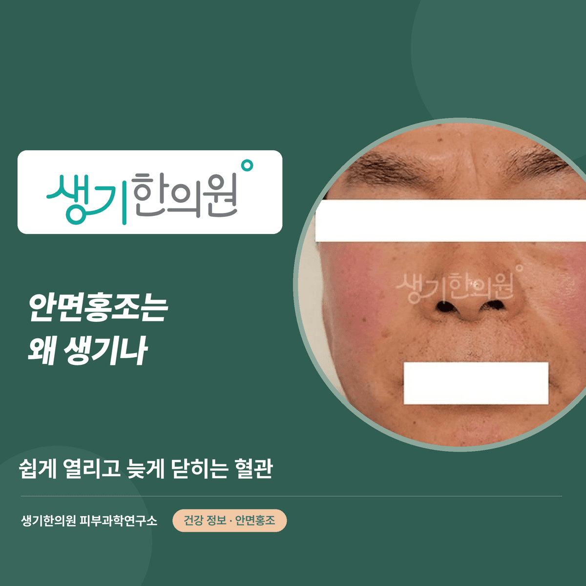 안면홍조는 왜 생기나 — 쉽게 열리고 늦게 닫히는 혈관 대표 이미지