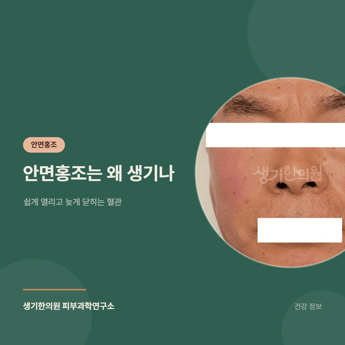안면홍조는 왜 생기나 — 쉽게 열리고 늦게 닫히는 혈관 대표 이미지