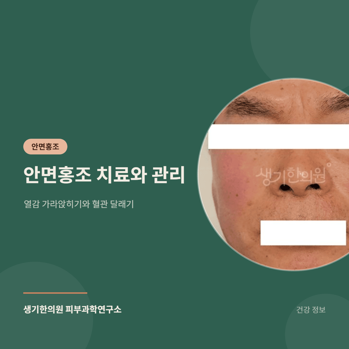 안면홍조 치료와 관리 — 열감 가라앉히기와 혈관 달래기 대표 이미지