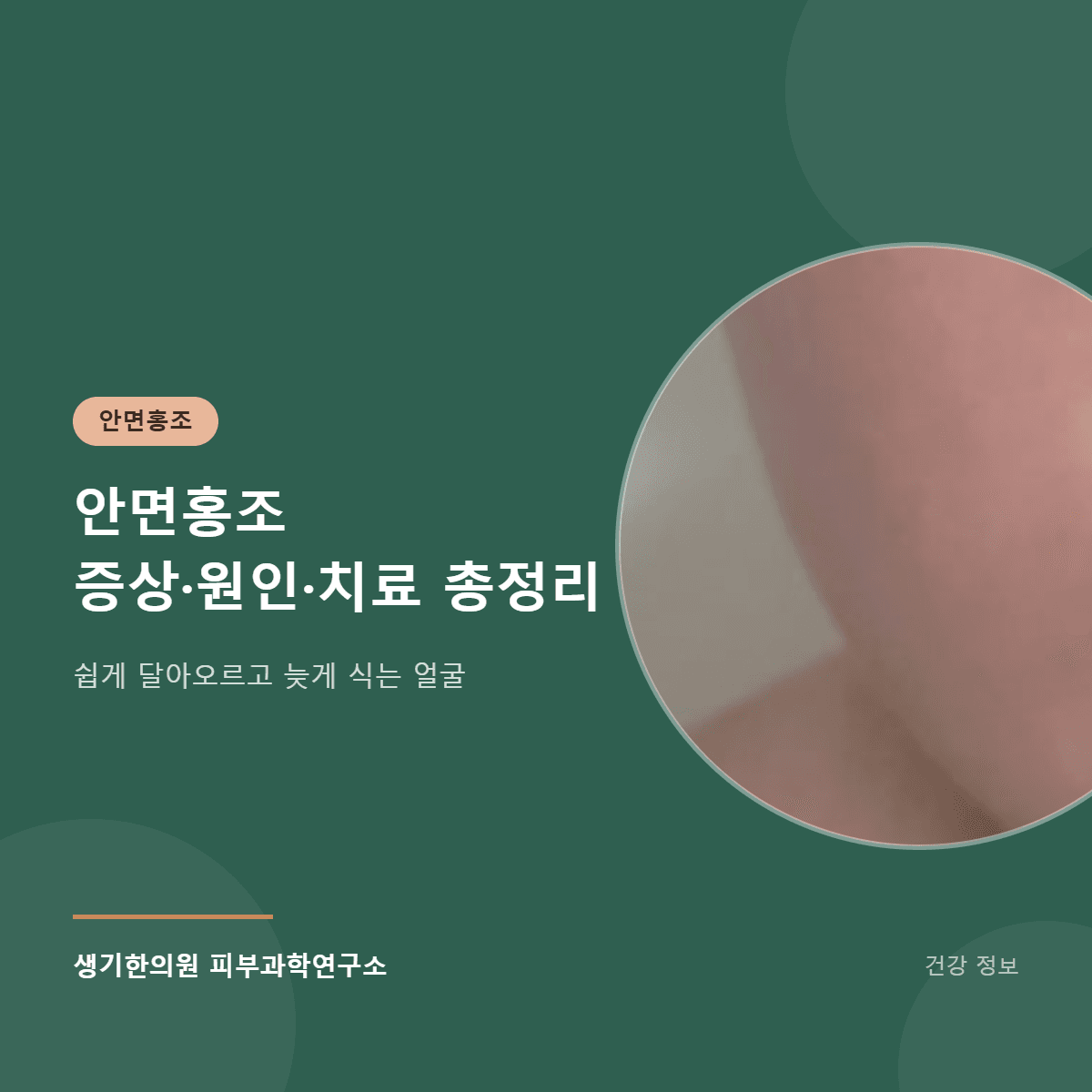 안면홍조 증상·원인·치료 총정리 대표 이미지