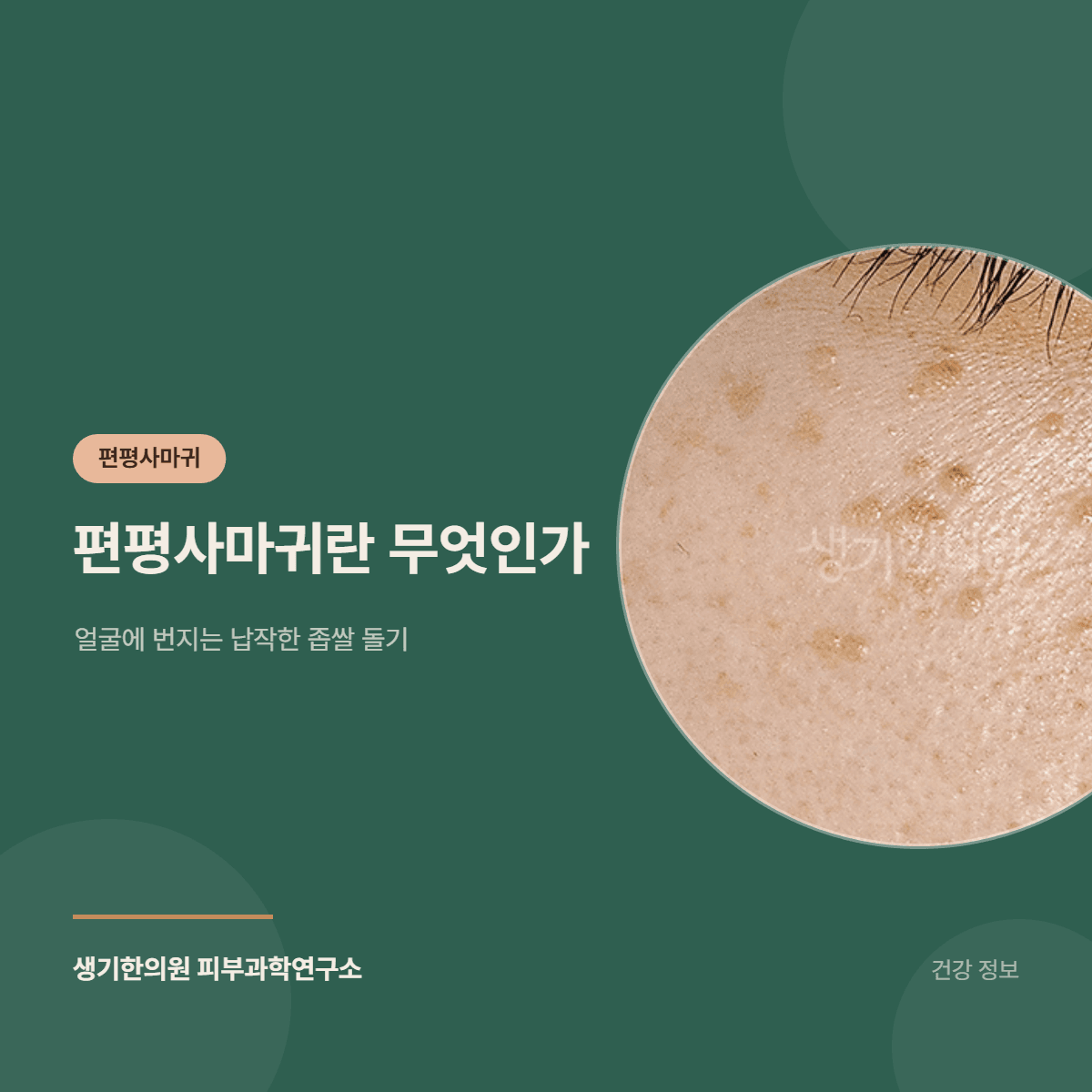 편평사마귀란 무엇인가 — 얼굴에 번지는 납작한 좁쌀 돌기 대표 이미지