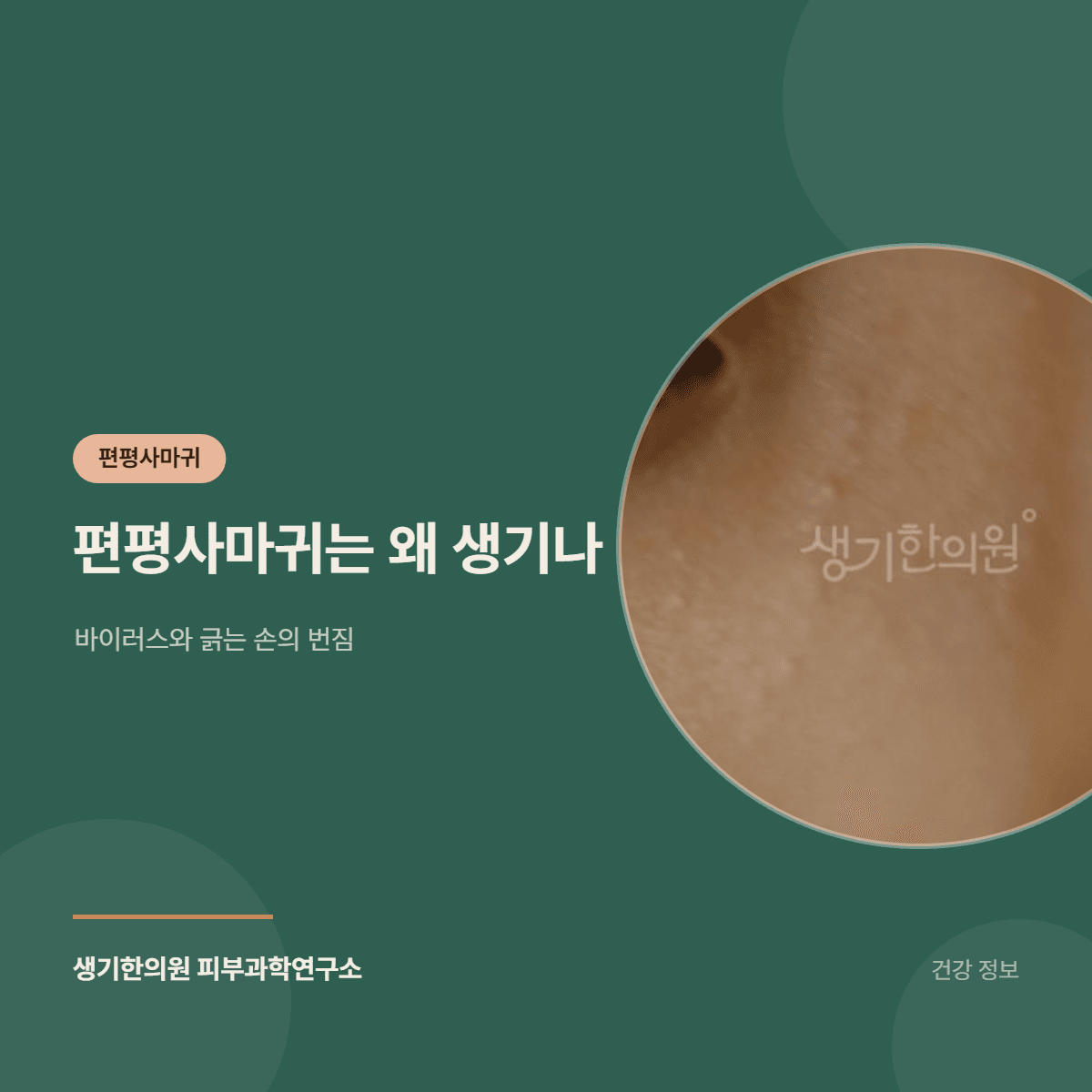 편평사마귀는 왜 생기나 — 바이러스와 긁는 손의 번짐 대표 이미지
