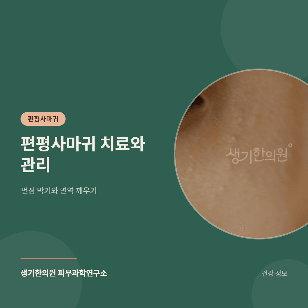 편평사마귀 치료와 관리 — 번짐 막기와 면역 깨우기 대표 이미지