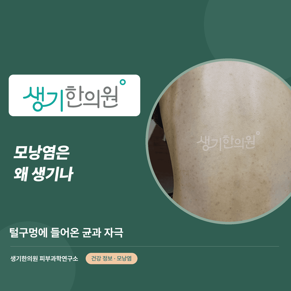 모낭염은 왜 생기나 — 털구멍에 들어온 균과 자극 대표 이미지