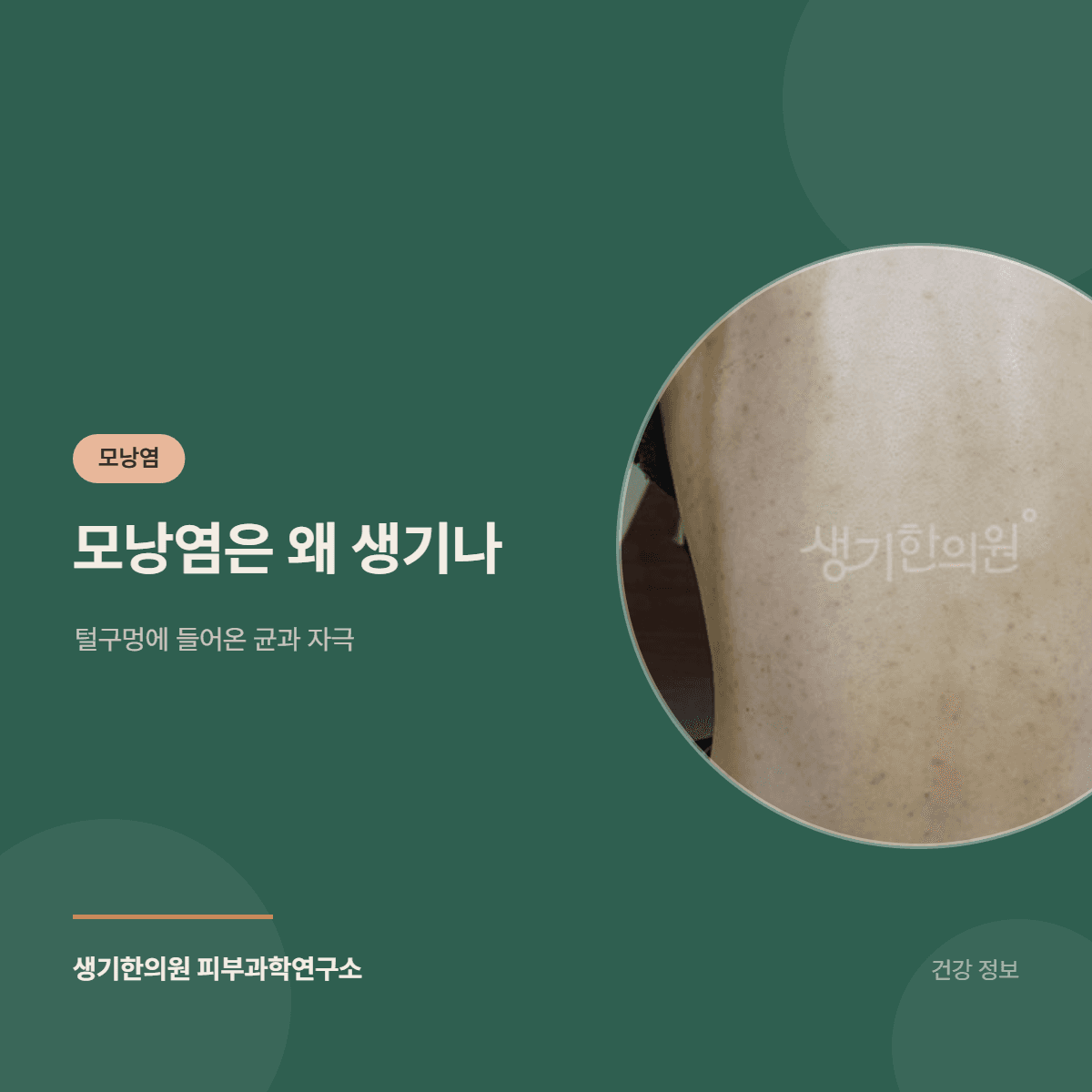 모낭염은 왜 생기나 — 털구멍에 들어온 균과 자극 대표 이미지