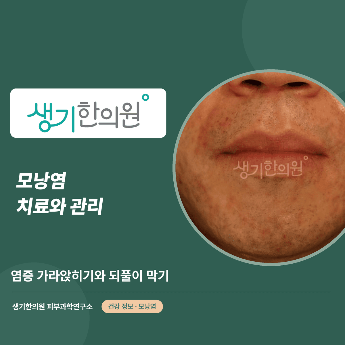모낭염 치료와 관리 — 염증 가라앉히기와 되풀이 막기 대표 이미지