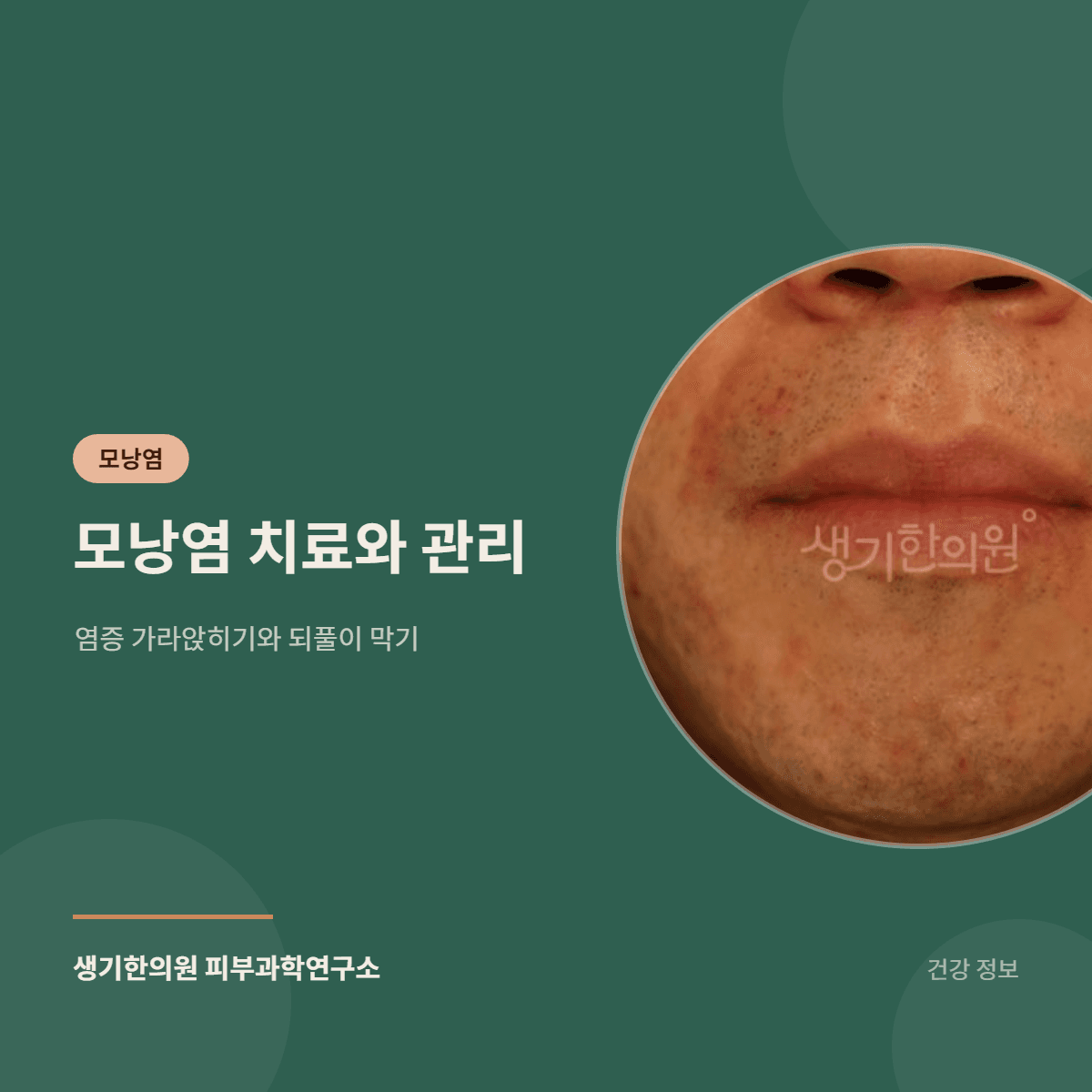 모낭염 치료와 관리 — 염증 가라앉히기와 되풀이 막기 대표 이미지