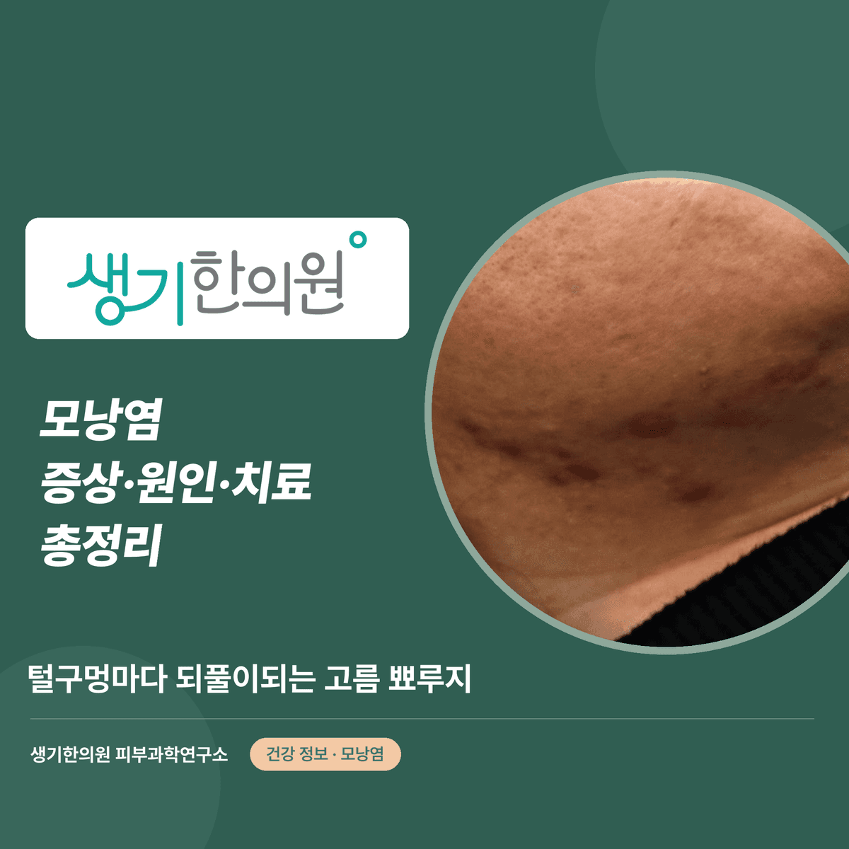 모낭염 증상·원인·치료 총정리 대표 이미지