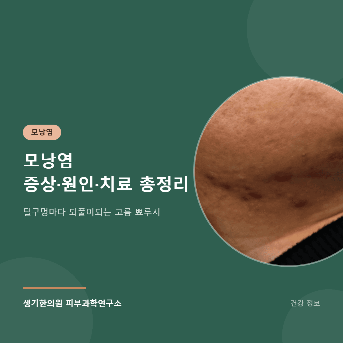 모낭염 증상·원인·치료 총정리 대표 이미지