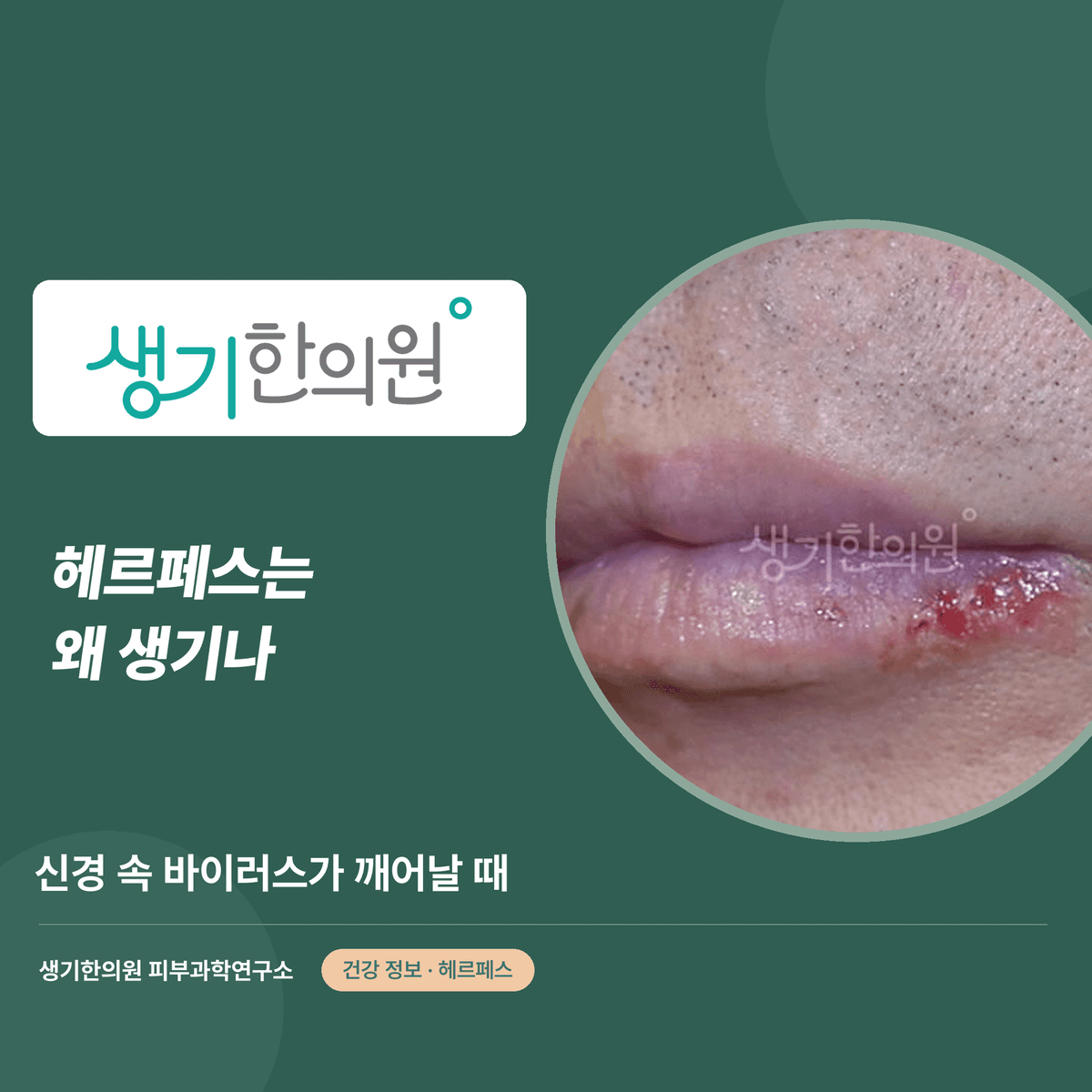 헤르페스는 왜 생기나 — 신경 속 바이러스가 깨어날 때 대표 이미지