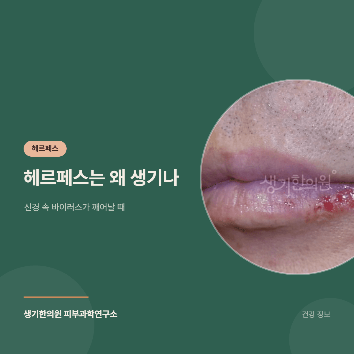 헤르페스는 왜 생기나 — 신경 속 바이러스가 깨어날 때 대표 이미지