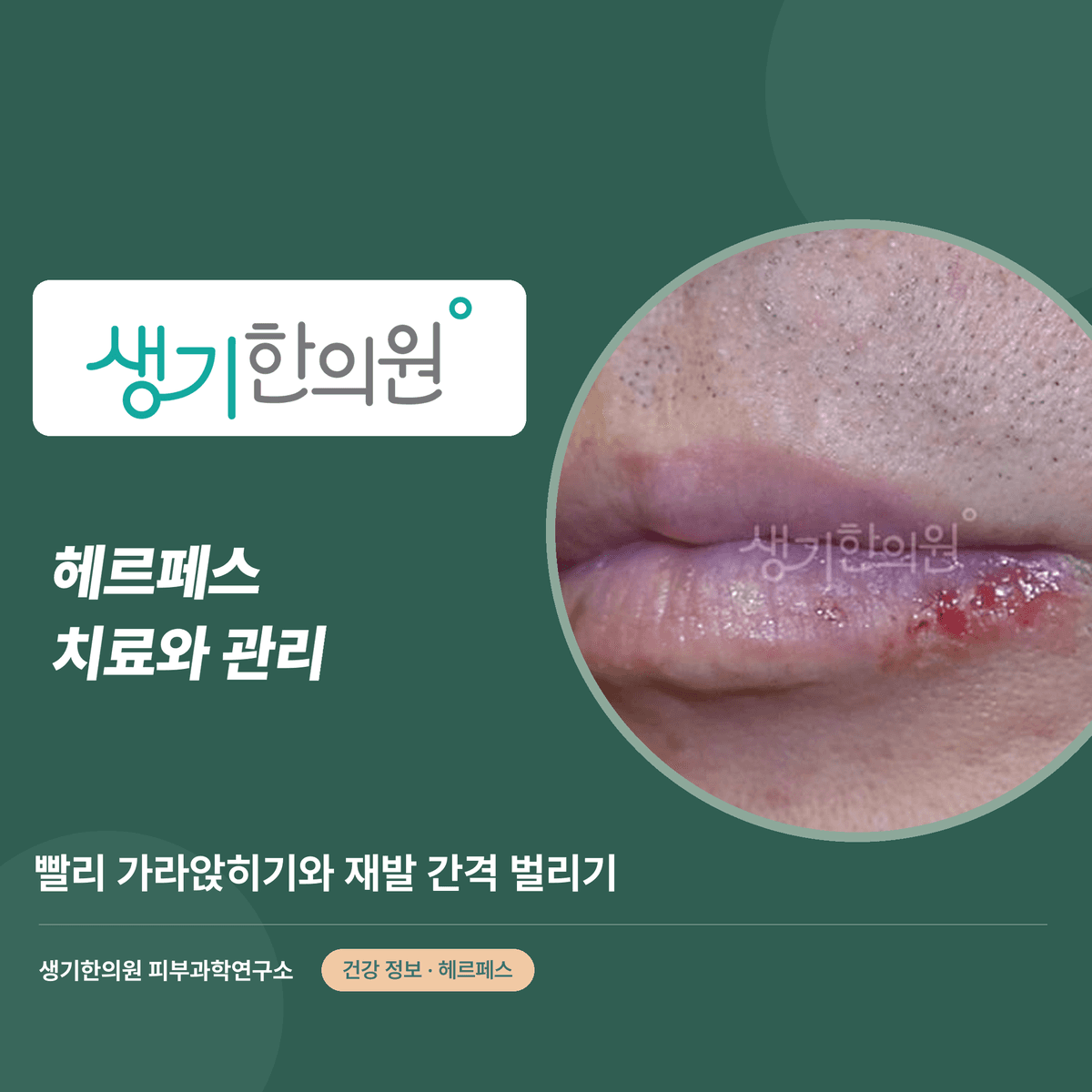 헤르페스 치료와 관리 — 빨리 가라앉히기와 재발 간격 벌리기 대표 이미지