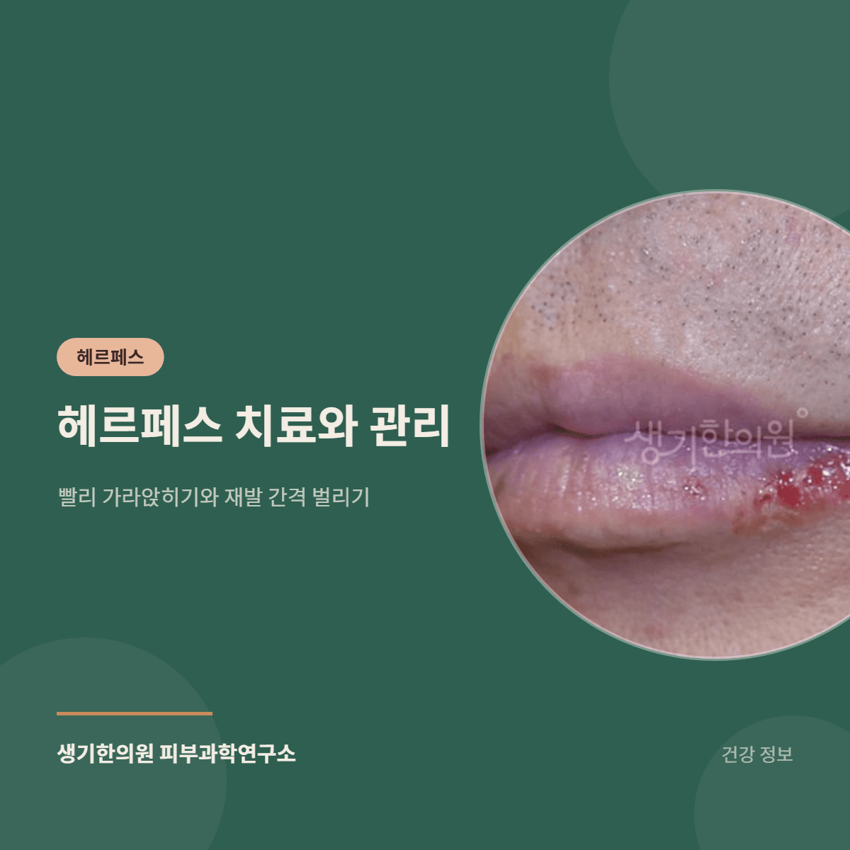 헤르페스 치료와 관리 — 빨리 가라앉히기와 재발 간격 벌리기 대표 이미지