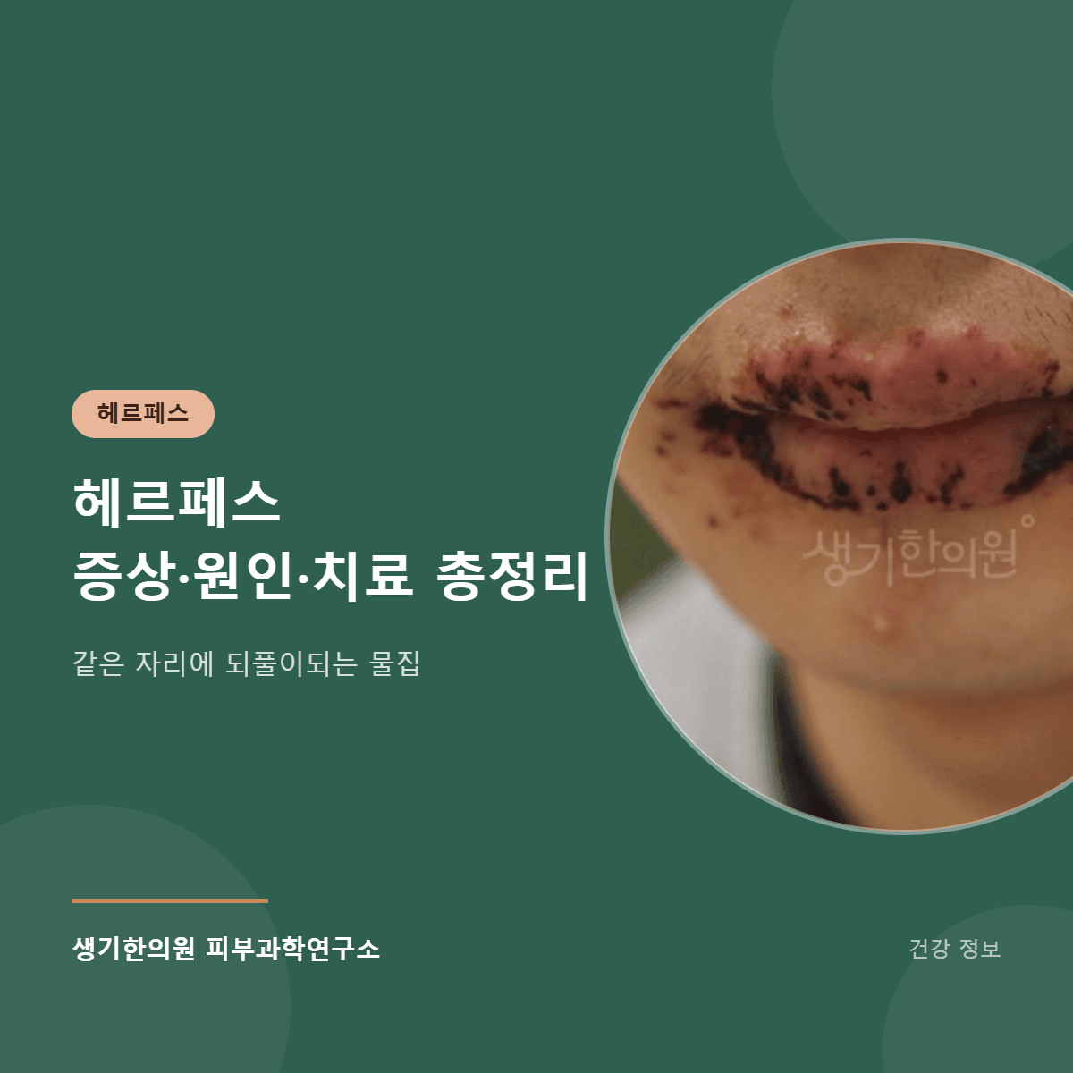 헤르페스 증상·원인·치료 총정리 대표 이미지