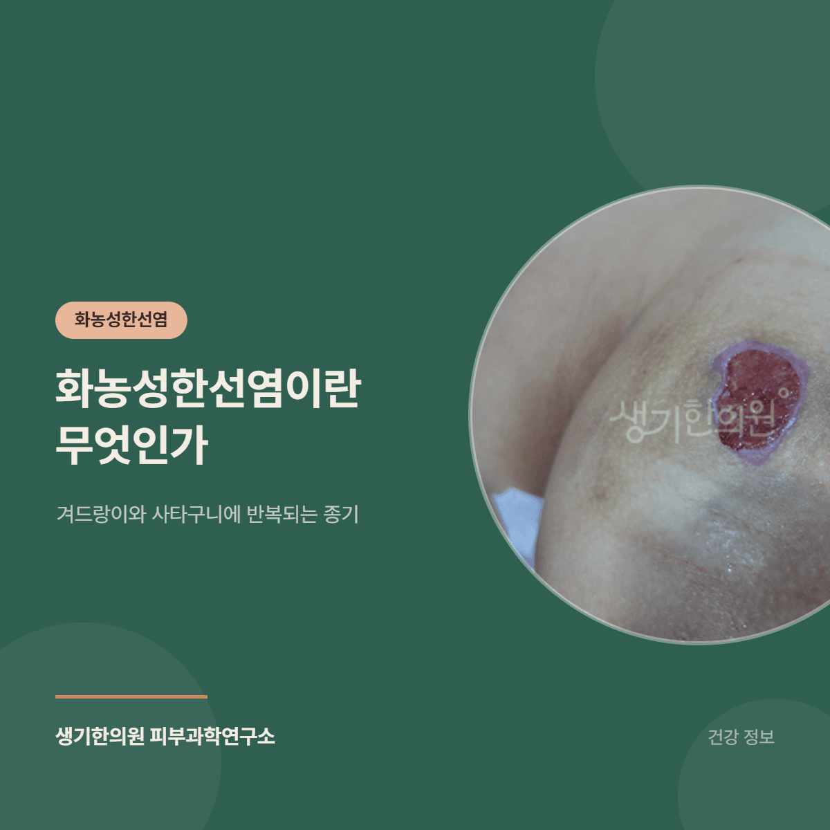화농성한선염이란 무엇인가 — 겨드랑이와 사타구니에 반복되는 종기 대표 이미지