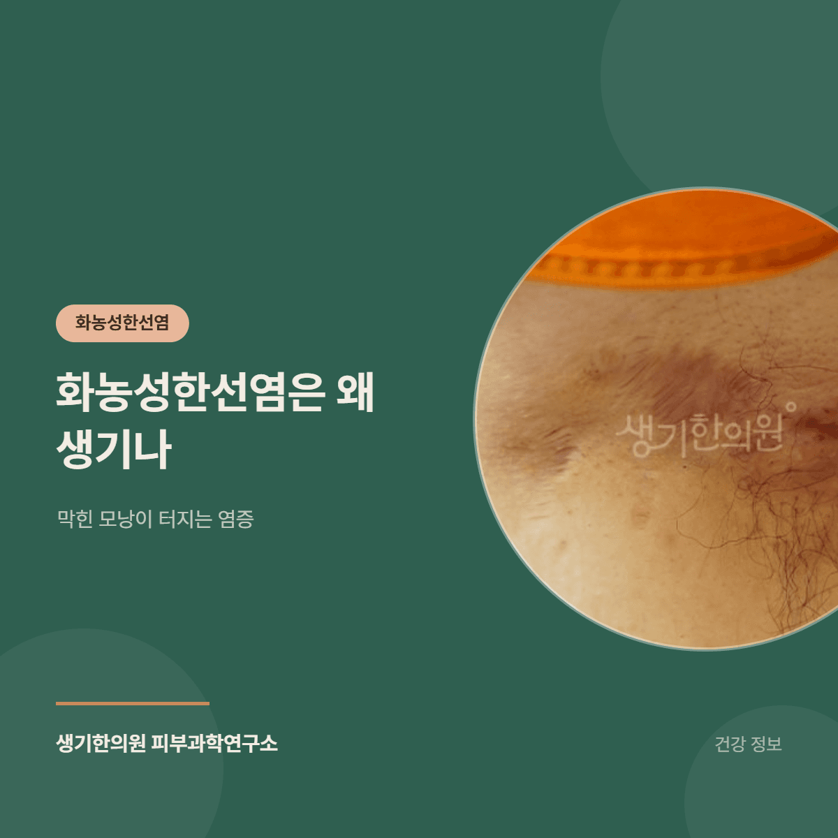 화농성한선염은 왜 생기나 — 막힌 모낭이 터지는 염증 대표 이미지