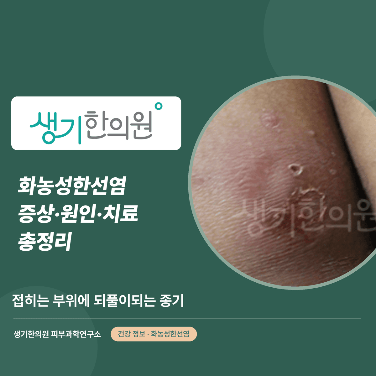 화농성한선염 증상·원인·치료 총정리 대표 이미지