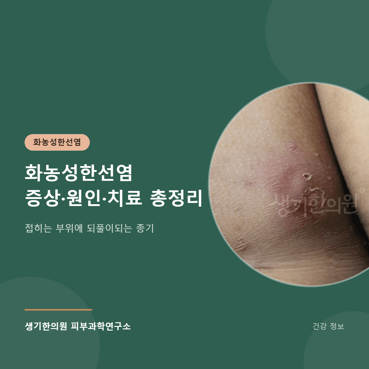 화농성한선염 증상·원인·치료 총정리 대표 이미지