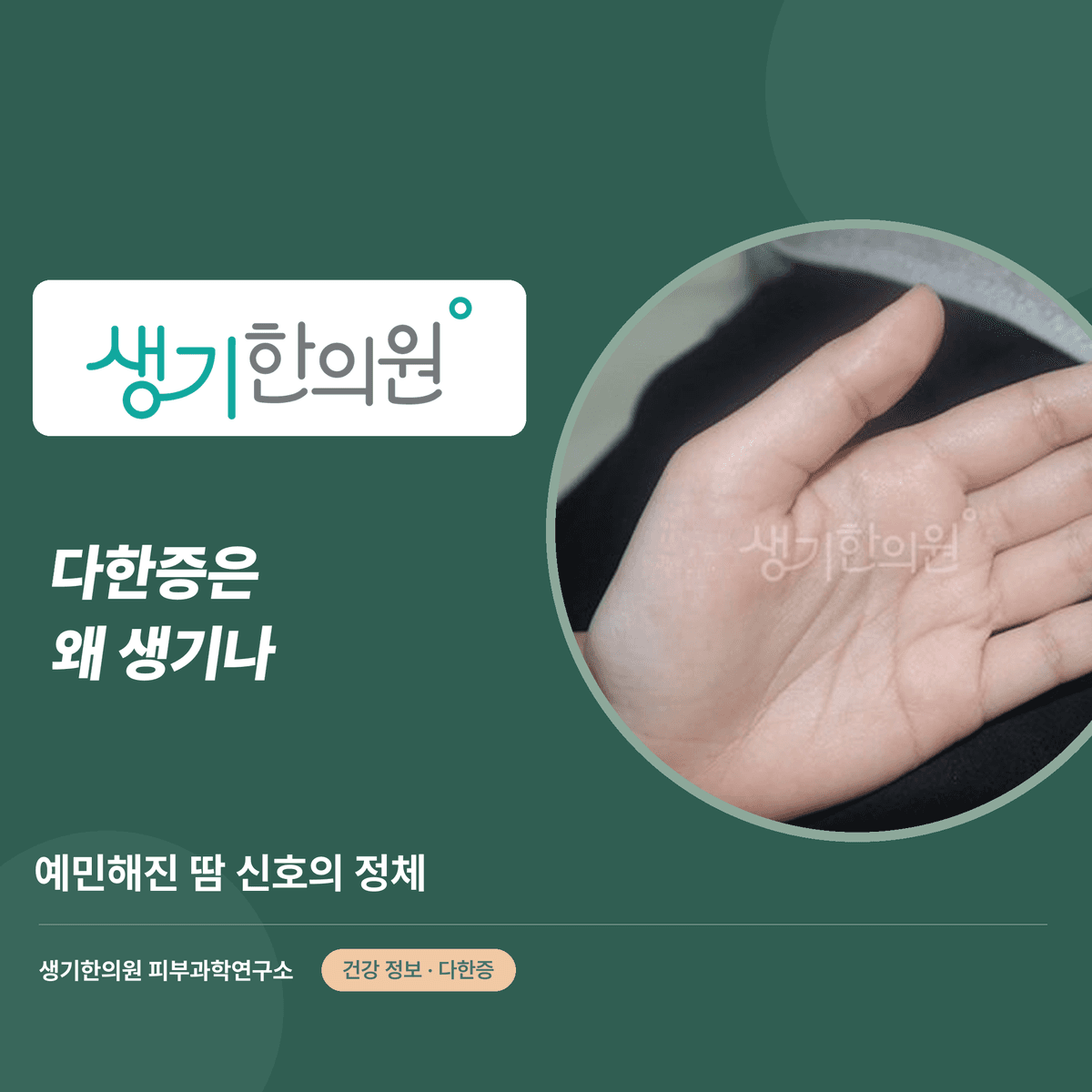 다한증은 왜 생기나 — 예민해진 땀 신호의 정체 대표 이미지