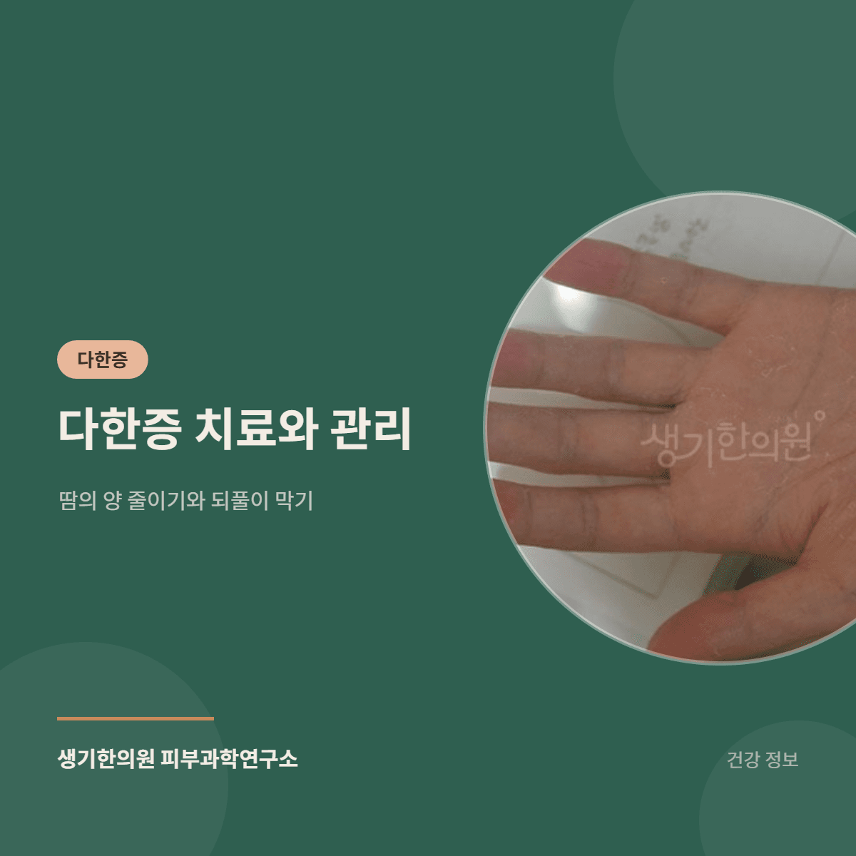 다한증 치료와 관리 — 땀의 양 줄이기와 되풀이 막기 대표 이미지