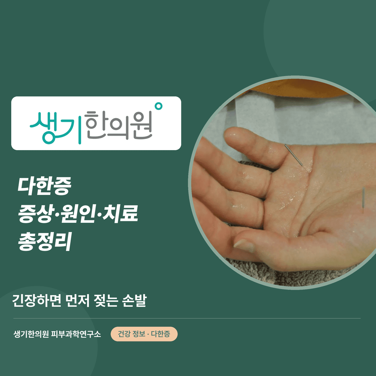 다한증 증상·원인·치료 총정리 대표 이미지