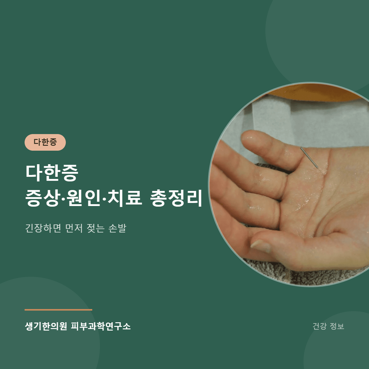 다한증 증상·원인·치료 총정리 대표 이미지